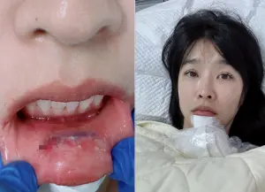 小嫻跌倒下巴重擊！「門牙凹進去」口內血痕曝光：整個人好暈
