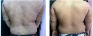 ▲患者原本軀幹有大面積苔蘚化病變,治療後不僅苔蘚化明顯消失,皮膚癢感也減輕許多。(圖/台大新竹分院提供) ▲患者原本軀幹有大面積苔蘚化病變,治療後不僅苔蘚化明顯消失,皮膚癢感也減輕許多。(圖/台大新竹分院提供)