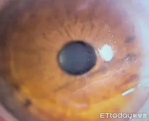 ▲余女的右眼眼角膜有數條刮痕。(圖/洪啟庭醫師提供) ▲余女的右眼眼角膜有數條刮痕。(圖/洪啟庭醫師提供)