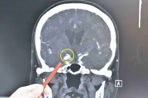 ▲病人的動脈瘤已壓迫動眼神經,所幸在破裂、出血造成昏迷前及時處理。(圖/彰化基督教醫院提供) ▲病人的動脈瘤已壓迫動眼神經,所幸在破裂、出血造成昏迷前及時處理。(圖/彰化基督教醫院提供)