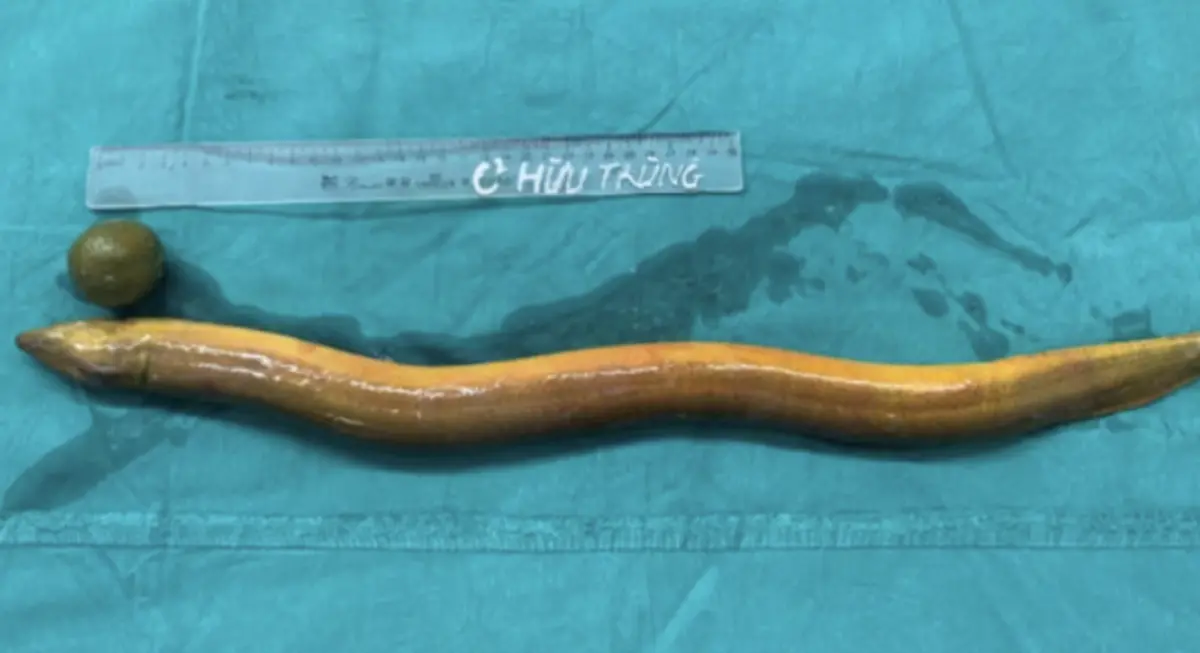 ▲越南醫生從一名31歲男子的腹內取出一條活鰻魚和青檸檬，男子供稱自己將他們塞到肛門內。（圖／翻攝自X）