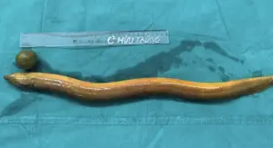 65公分鰻魚塞肛門!年輕男子險丟性命 越南醫生幫忙取出