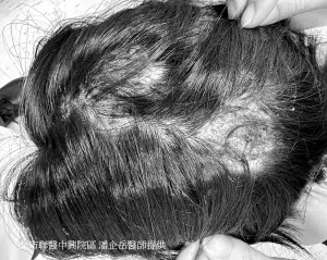 8歲女童頭皮「化膿又落髮」！兇手是頭癬　寵物有症狀也得一起治
