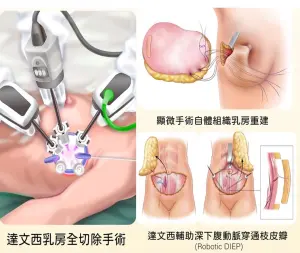 ▲基隆長庚醫院運用達文西手術進行乳房全切除，再以深下腹動脈穿通枝皮瓣完成立即性乳房重建。（圖／基隆長庚提供）