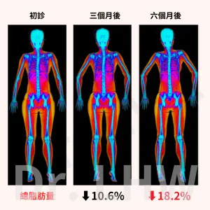 ▲DXA報告顯示陳小姐經治療後，腰、臀、大腿的脂肪（黃色部分）顯著減少，總脂肪量下降18.2%。（圖／廖虹雯提供）