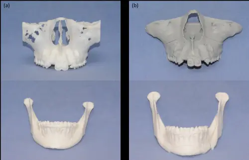 ▲3D列印的顎骨模型手術前（圖左）、手術後對照。（圖／奇美醫院提供）