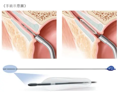 ▲要完成耳咽管氣球擴張成型術，醫師須將獨特設計的氣球導管置入耳咽管內，撐開耳咽管狹窄部分，即可恢復耳咽管暢通。（圖／北市聯醫提供）