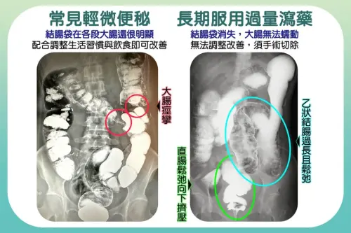 ▲患者過度依賴瀉藥，大腸已無結腸袋，失去正常蠕動功能。 （圖／台中慈濟醫院提供）