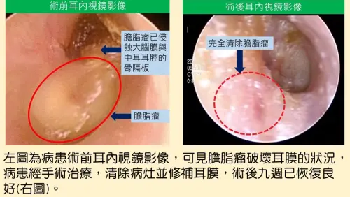 ▲振興醫院治癒Rosa的耳內膽脂瘤，助她右耳重拾聽力。（圖／振興醫院提供）