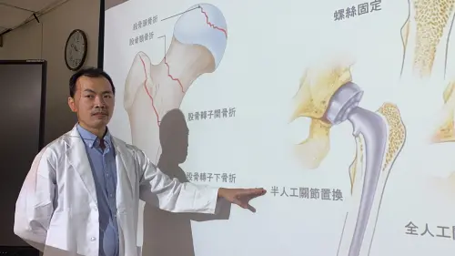 87歲婦人半年內接連摔斷兩腿 醫師:骨折是可以預防的