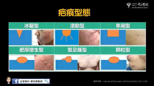 ▲疤痕型態多元，應針對不同種類與嚴重度選擇不同的複合性治療模式。（圖／奇美醫院提供）