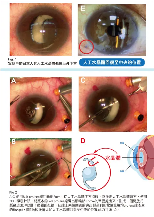 ▲透過經鞏膜縫合固定法，可將脫位的人工水晶體直接復位。（圖／振興醫院提供）