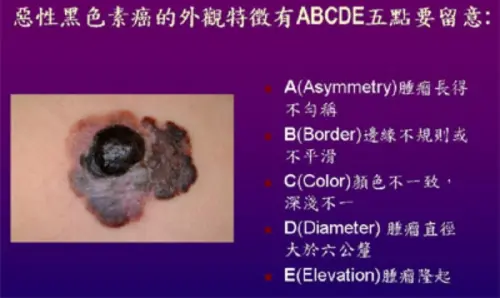 ▲黑色素癌外觀特徵的5個判別方式。（圖 / 台北榮總官網）