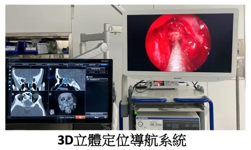 ▲透過3D鼻竇定位導航系統，可清楚掌握黃小姐的鼻竇黏液囊腫位置，並安全切除。（圖／中山附醫提供）