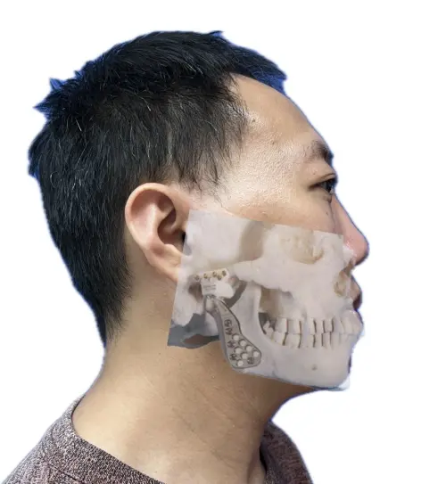 ▲葉先生接受「全人工顳顎關節置換手術」後，臉部恢復對稱，並重拾咀嚼功能。（圖／林口長庚醫院提供）