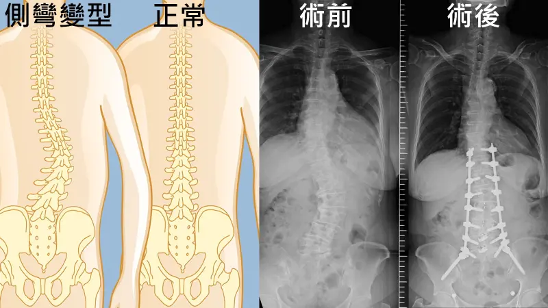 ▲林婆婆脊椎側彎一度彎曲超過40度，到台北榮總接受微創手術後大幅改善。（圖／台北榮總提供）