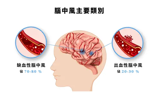 ▲腦中風分「出血性」與「缺血性」。（圖／澄清醫院中港分院官網）