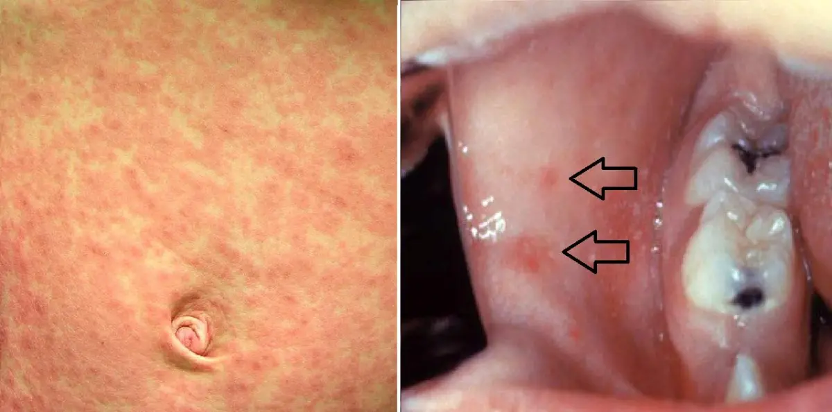 ▲越南近期麻疹疫情嚴重，我國疾管署提升越南的旅遊警戒。（示意圖／Icu醫生陳志金臉書）