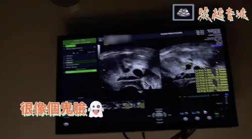 ▲藝人鬼鬼今(10)日無預警宣布產女晉升人母,而她早在2022年就進行凍卵療程,手術過程全曝光。(圖/翻攝自鬼鬼吳映潔官方YouTube) ▲▲藝人鬼鬼今(10)日無預警宣布產女晉升人母,而她早在2022年就進行凍卵療程,手術過程全曝光。(圖/翻攝自鬼鬼吳映潔官方YouTube)