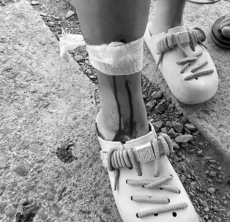 ▲台灣也曾發生水豚咬傷人的事件。（圖／翻攝Dcard）