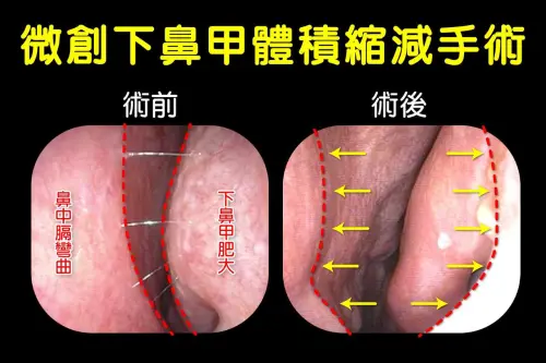 ▲廖小姐微創下鼻甲體積縮減手術的術前、術後對照。（圖／台中慈院提供）
