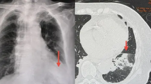 ▲醫生斷定此名女子染上「退伍軍人病」併發肺炎。（圖／翻攝自臉書）