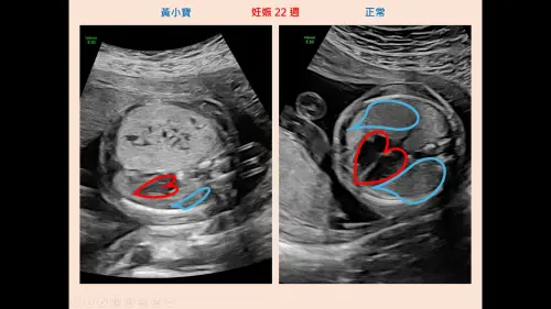 產檢「胎兒肺部有腫瘤」！肺畸形擠偏心臟　撐到足月剖腹成功搶命
