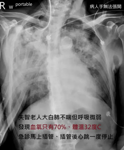 ▲蘇一峰醫師提醒，「大白肺」患者需要留意低溫帶來的低血氧，可能會用昏睡來表現。（圖／翻攝蘇一峰臉書）