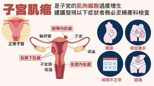 ▲子宮肌瘤雖是常見腫瘤,若造成大出血仍恐威脅生命。(圖/振興醫院提供) ▲子宮肌瘤雖是常見腫瘤,若造成大出血仍恐威脅生命。(圖/振興醫院提供)