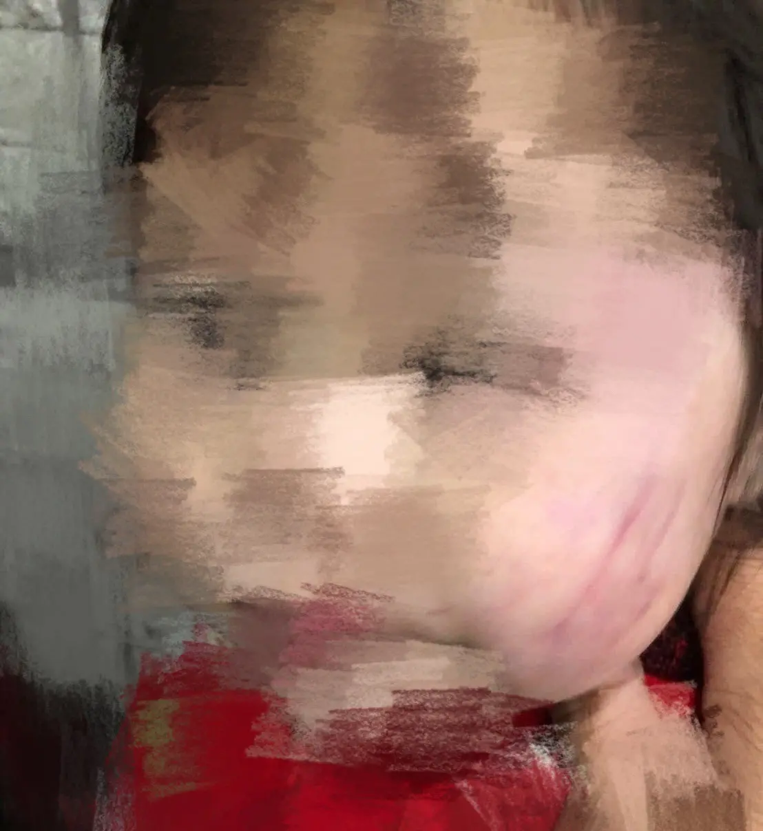 ▲台南一名母親送1歲的女兒去補習班，沒想到接女兒回家時看到臉上有大片抓痕及瘀青，業者聲稱是遭口水巾壓到所致，甚至還打電話要求這名母親「不要驗傷，否則會完蛋」。（圖／翻攝臉書）