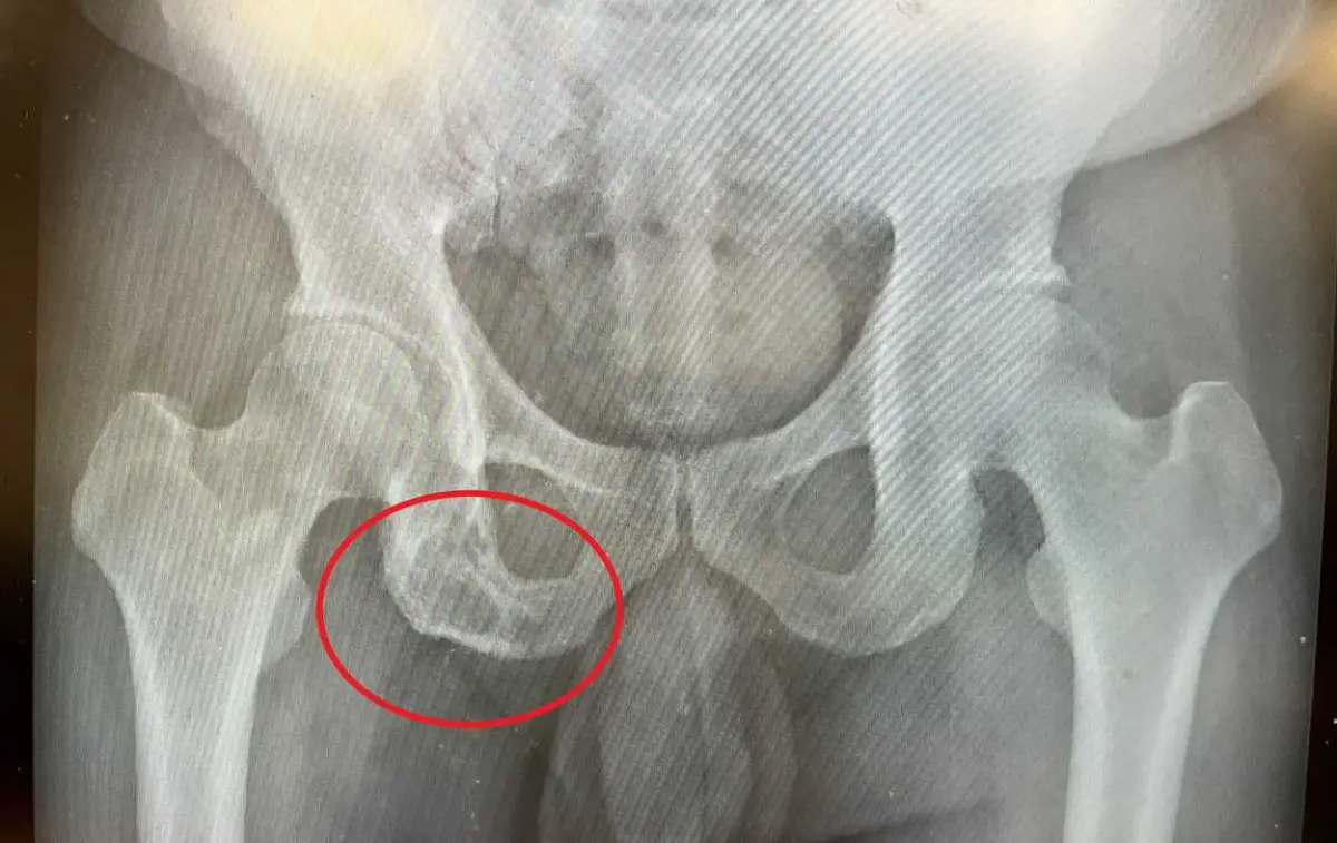 ▲白先生右側臀部疼痛，以為是工作太累，就醫時發現，坐骨骨頭已遭侵蝕。（圖／台中慈願提供）