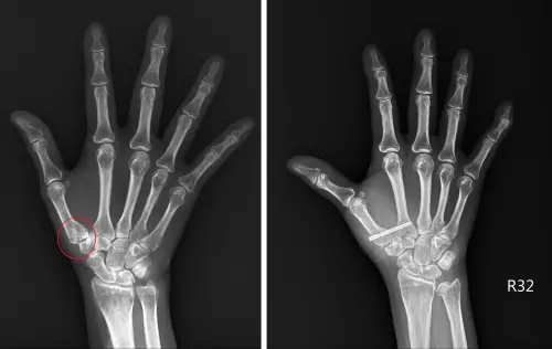 ▲患者術前X光可發現拇指根部關節有滑脫情形（左），新型微創手術用鈦合金或可吸收螺絲將其固定在第二掌骨基部（右），順利改善症狀。（圖／台北慈院提供）