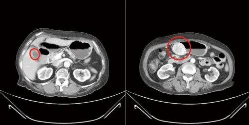 ▲林女士不僅胃部長出胃腸道基質瘤,膽囊也嚴重發炎。(圖/國泰醫院提供) ▲林女士不僅胃部長出胃腸道基質瘤,膽囊也嚴重發炎。(圖/國泰醫院提供)