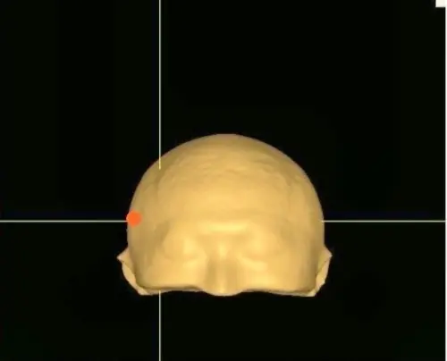 ▲應用3D技術定位右側前額下迴(橘色處)。(圖/長庚醫院提供) ▲應用3D技術定位右側前額下迴(橘色處)。(圖/長庚醫院提供)