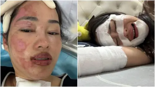 女子被燒傷後送醫,公開復原情況。(圖/翻攝自臉書) ▲女子被燒傷後送醫,公開復原情況。(圖/翻攝自臉書)