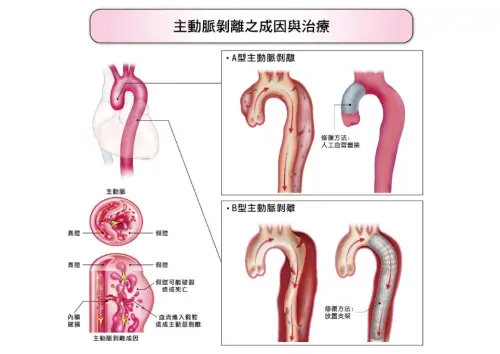 ▲主動脈剝離的成因與治療。(圖/長庚醫院提供) ▲主動脈剝離的成因與治療。(圖/長庚醫院提供)