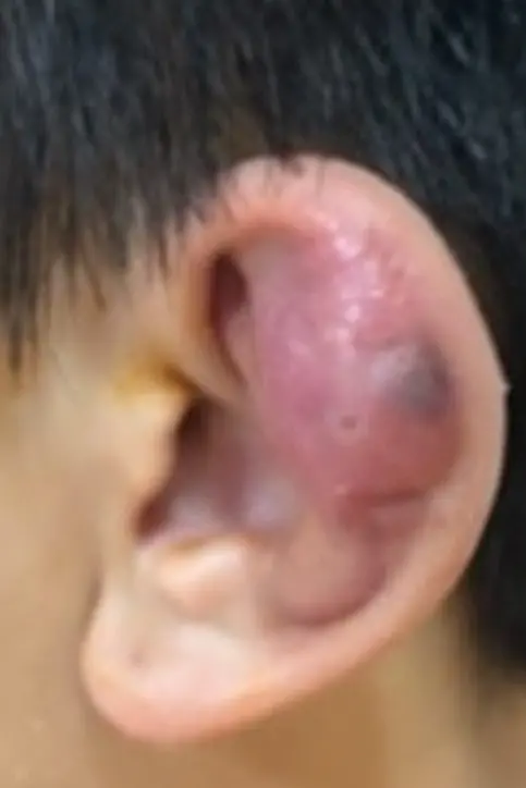 ▲周同學耳骨打洞感染綠膿桿菌,爆發蜂窩性組織炎。(圖/台北慈院提供) ▲周同學耳骨打洞感染綠膿桿菌,爆發蜂窩性組織炎。(圖/台北慈院提供)