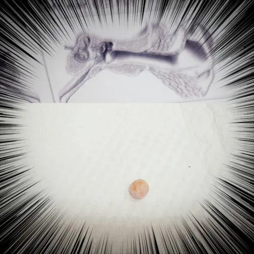 9歲女孩耳朵內竟塞入一顆半公分大的泡綿球,醫師夾出相當驚訝。(圖/阿包醫生陪你養寶包 - 小兒科巫漢盟醫師臉書) ▲9歲女孩耳朵內竟塞入一顆半公分大的泡綿球,醫師夾出相當驚訝。(圖/阿包醫生陪你養寶包 - 小兒科巫漢盟醫師臉書)