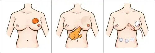 ▲大網膜自體皮瓣乳房重建技術術式流程:乳房腫瘤切除→腹腔大網膜拉出→手術後傷口及引流管。(圖/台大醫院護理師彭譯平繪) ▲大網膜自體皮瓣乳房重建技術術式流程:乳房腫瘤切除→腹腔大網膜拉出→手術後傷口及引流管。(圖/台大醫院護理師彭譯平繪)