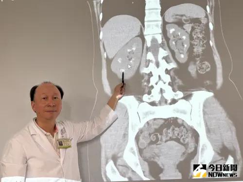 雙腎狂長結石像「滿天星」 竟是副甲狀腺亢進併發