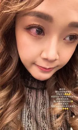 賴慧如上傳眼球充血照,嚇瘋粉絲。(圖/賴慧如IG) ▲賴慧如上傳眼球充血照,嚇瘋粉絲。(圖/賴慧如IG)