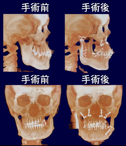 ▲電腦斷層影像可見患者原本上、下顎歪斜與顏面不對稱，在手術後明顯改善。（圖／林口長庚醫院提供）