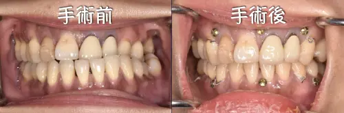 ▲病人的咬合不正於術後獲大幅減輕。（圖／林口長庚醫院提供）