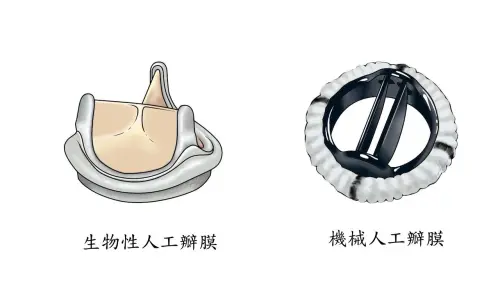 ▲人工瓣膜對照圖,長庚醫院大型研究揭露置換人工瓣膜的原則不宜以年齡一刀切。(圖/長庚醫院提供) ▲人工瓣膜對照圖,長庚醫院大型研究揭露置換人工瓣膜的原則不宜以年齡一刀切。(圖/長庚醫院提供)