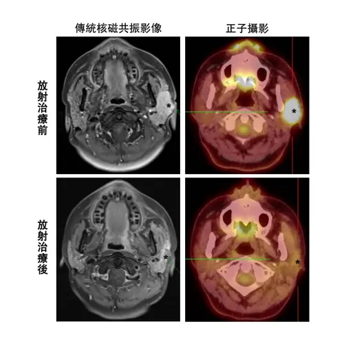 ▲傳統核磁共振影像（左上與左下）較難判別唾液腺癌放療發炎反應或殘存腫瘤（綠色箭頭與星號），正子攝影（右上與右下）能更準確評估療效（星號）。（圖／長庚醫院提供）