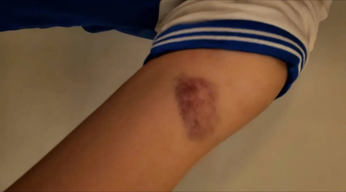 ▲南投縣某國小六年級導師對學生體罰，孩子雙臂嚴重瘀傷。（圖／翻攝網路，2025.05.01）