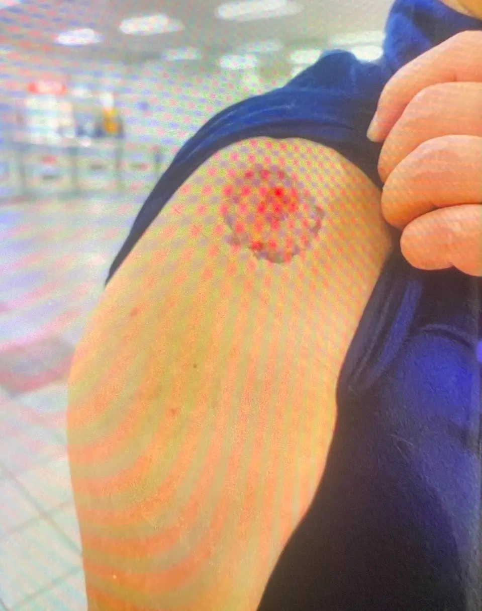 ▲勸阻咬人嫌犯的台北捷運王姓乘客遭咬傷手臂。（圖／警方提供）