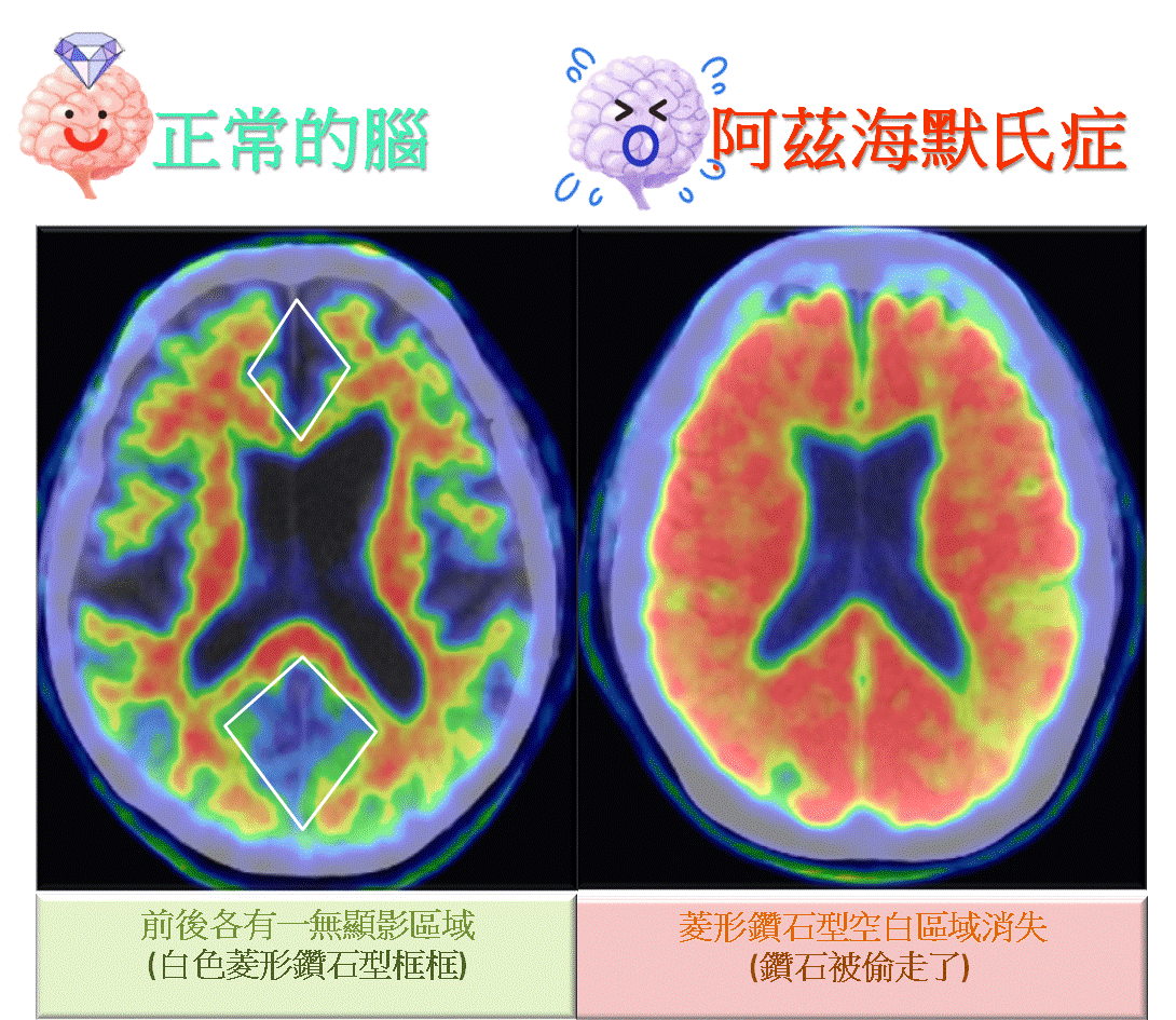 ▲「澱粉樣蛋白斑塊」堆積，恰好就是阿茲海默症的關鍵特徵。（示意圖／翻攝高雄榮民總醫院網站）