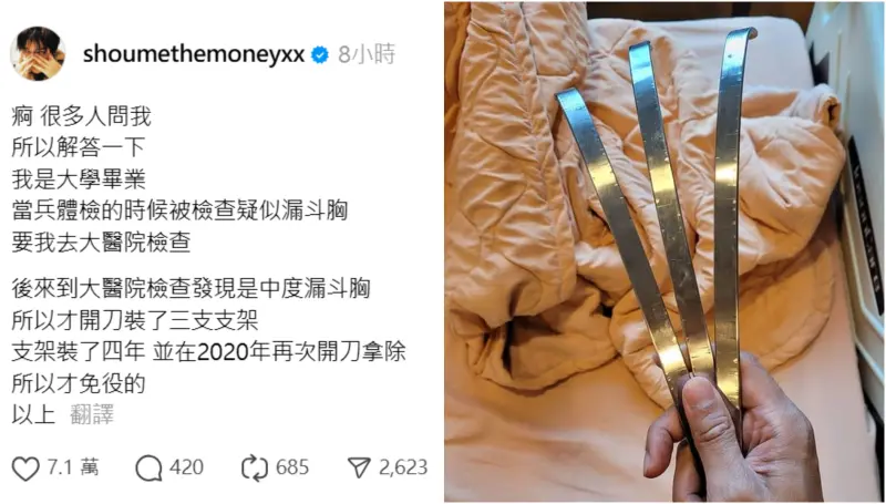 ▲婁峻碩因中度漏斗胸,胸腔裝過3支超粗支架。(圖/婁峻碩臉書、Threads)