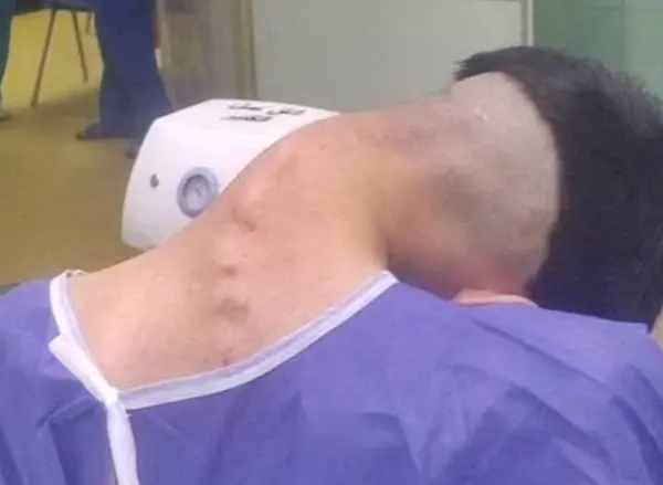 ▲伊朗伊斯法罕札赫拉大學醫院（Al-Zahra University Hospital）近日公布了一起罕見病例，一名23歲男子因為染上毒癮多年，頸部肌肉無力，導致脖子嚴重彎曲近乎90度。（圖／翻攝自Al-Zahra University Hospital）